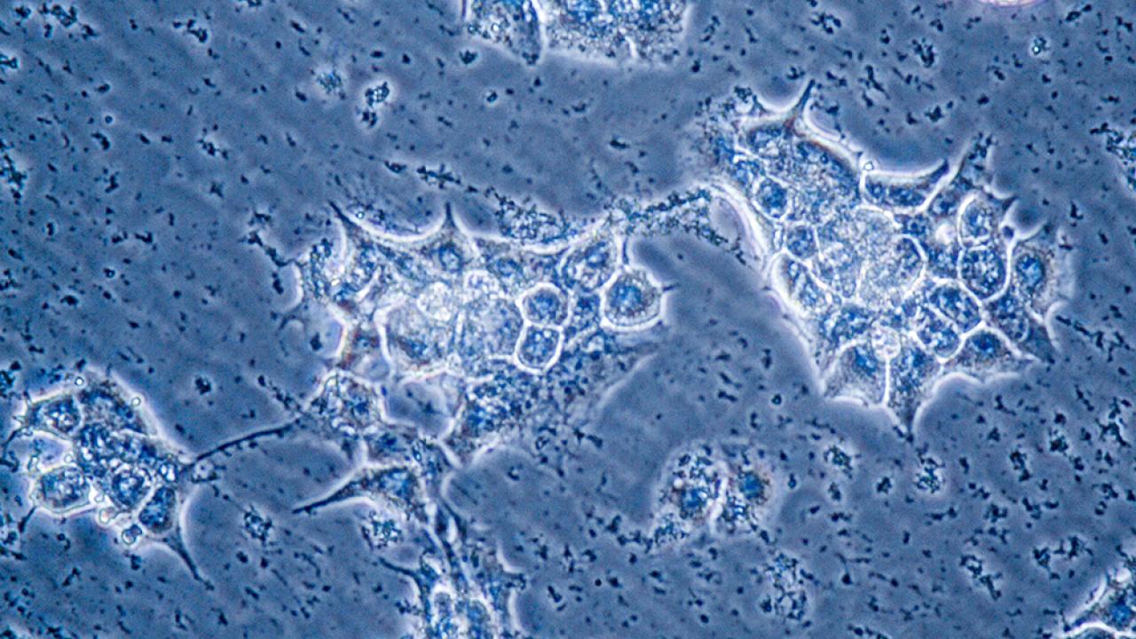 Breast cancer cells under microscope