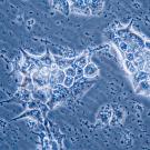 Breast cancer cells under microscope